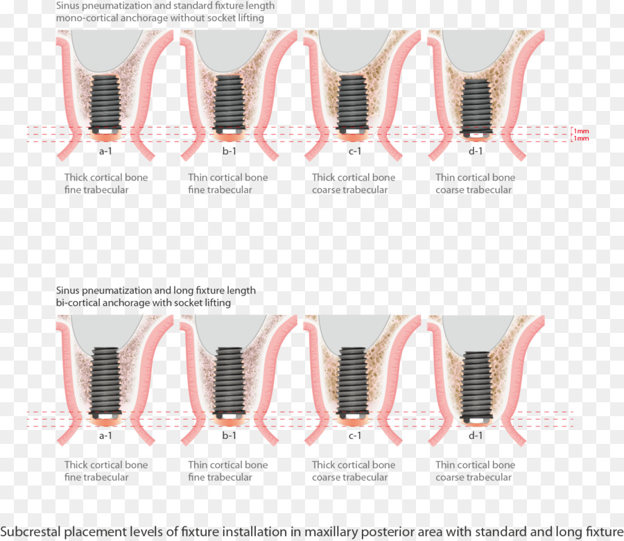 Implante Dentário，Do Seio Maxilar PNG