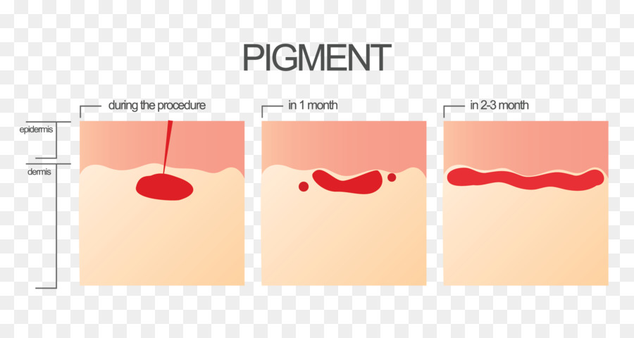 Pigmentação Da Pele，Procedimento PNG