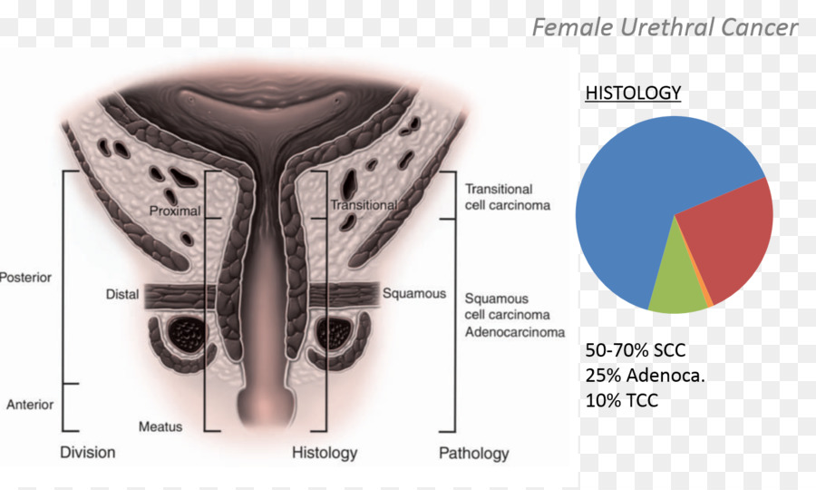 Diagrama De Câncer Uretral Feminino，Câncer PNG