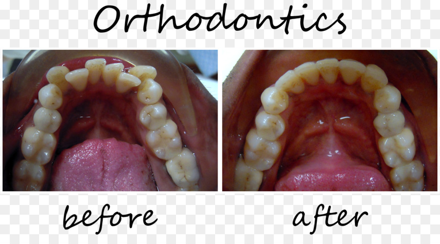 Ortodontia，Odontologia PNG