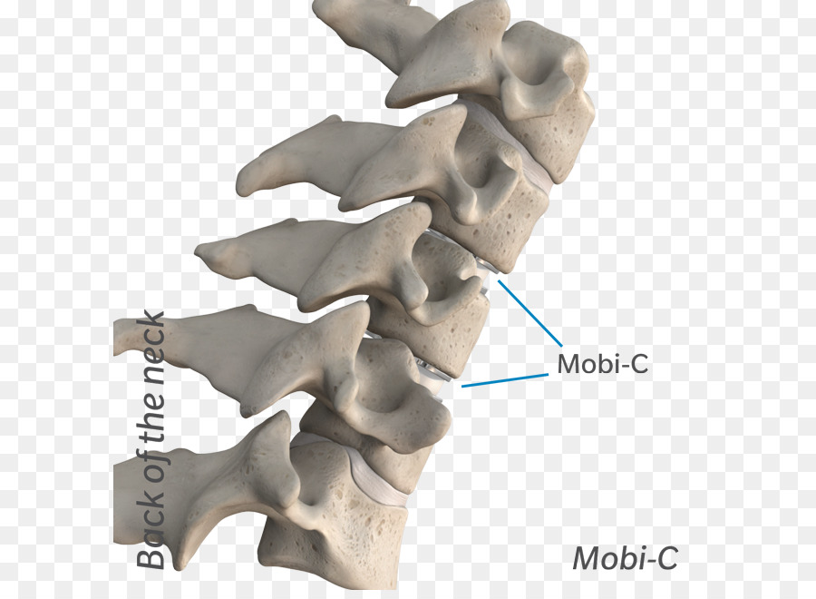 Disco Cervical，Cirurgia PNG