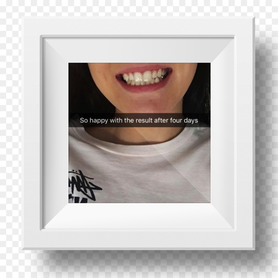 Branqueamento Dentário，Bleach PNG