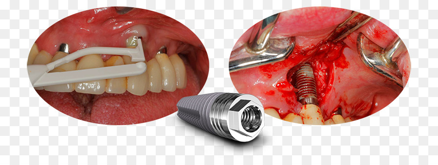 Automotivo Cauda Luz De Freio，Peri Implantites PNG