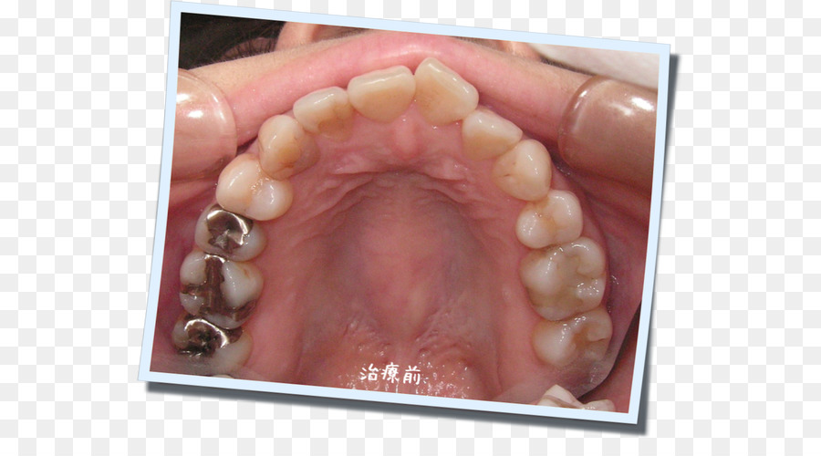 Nail，De Dentes Humanos PNG