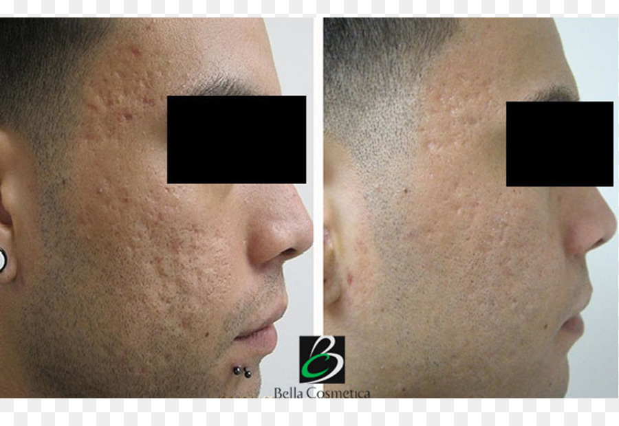 Tratamento De Acne，Pele PNG