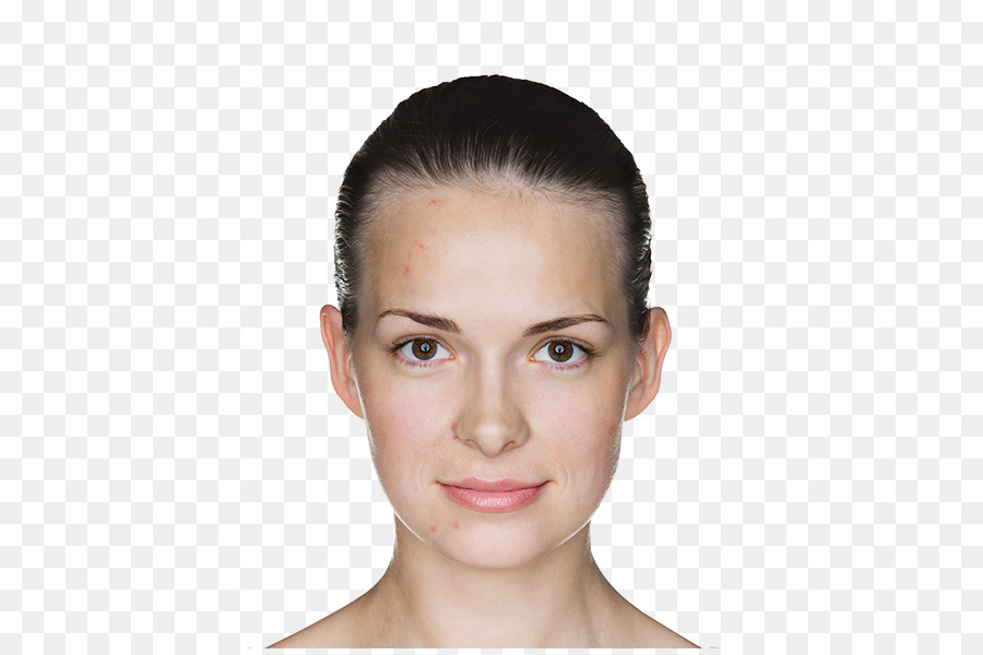 O Adapaleno，Acne PNG