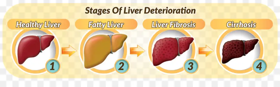 Estágios Da Deterioração Do Fígado，Fígado PNG