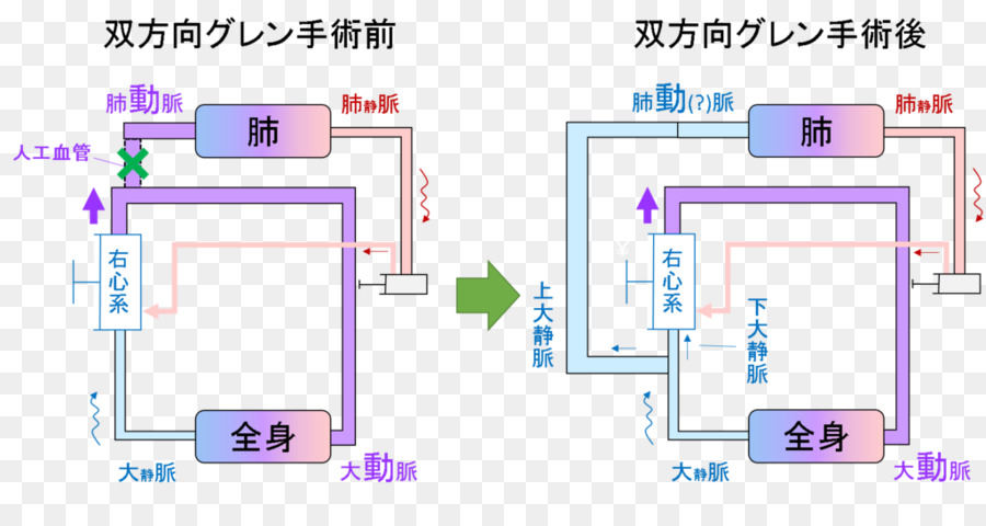 Fukuoka Municipal De Hospital Infantil，Hipoplasia De Coração Esquerdo Síndrome De PNG