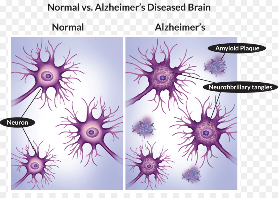 A Doença De Alzheimer，Fotografia De Stock PNG