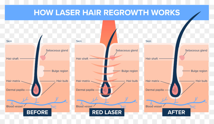 Crescimento Capilar A Laser，Cabelo PNG