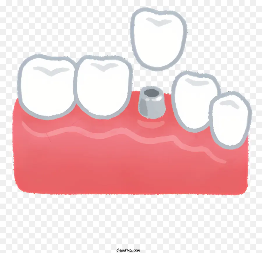 Implante Dentário，Canal De Raiz PNG